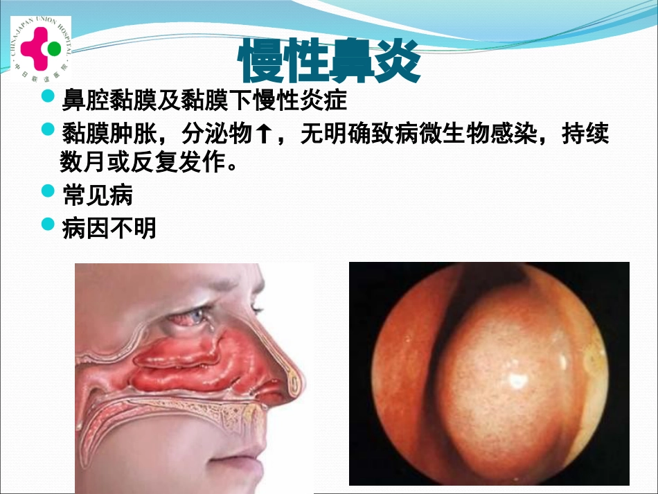 白求恩医疗班慢性鼻炎变应性鼻炎鼻息肉讲义_第10页