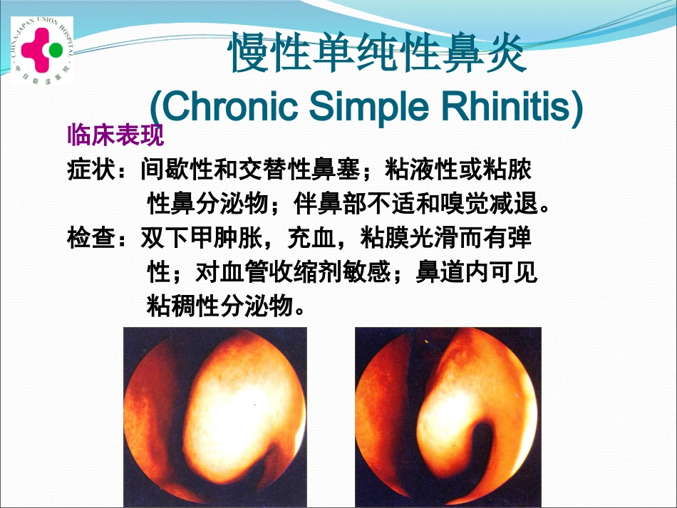 白求恩医疗班慢性鼻炎变应性鼻炎鼻息肉讲义_第12页