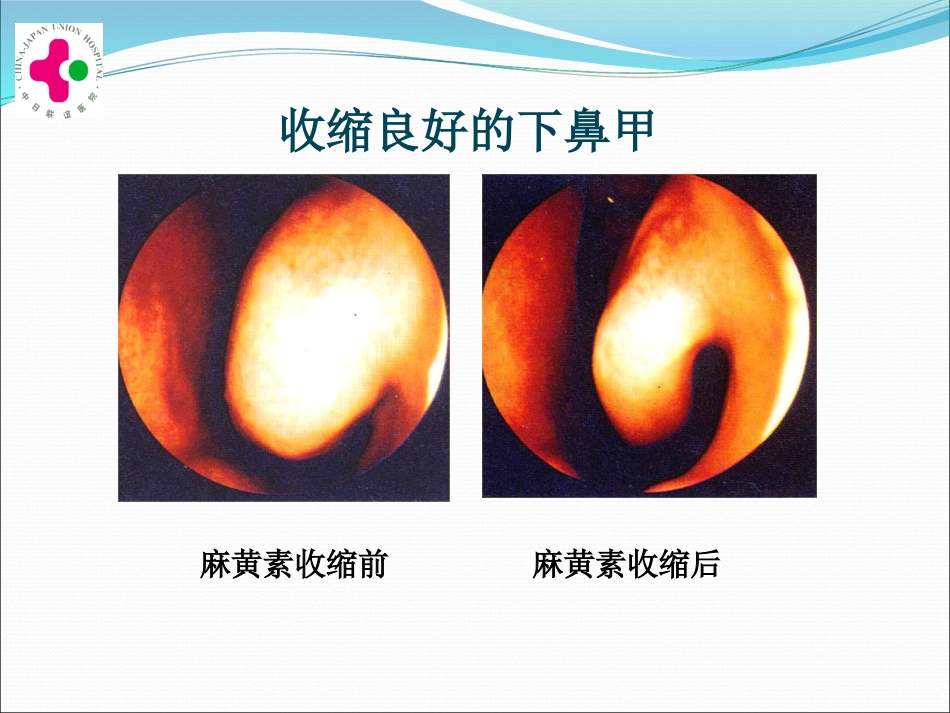 白求恩医疗班慢性鼻炎变应性鼻炎鼻息肉讲义_第13页