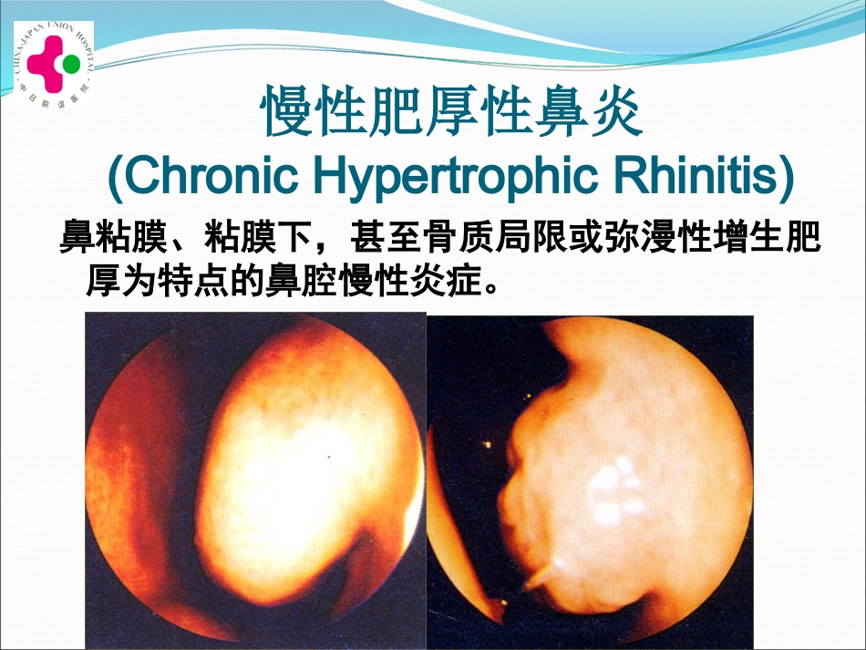 白求恩医疗班慢性鼻炎变应性鼻炎鼻息肉讲义_第15页