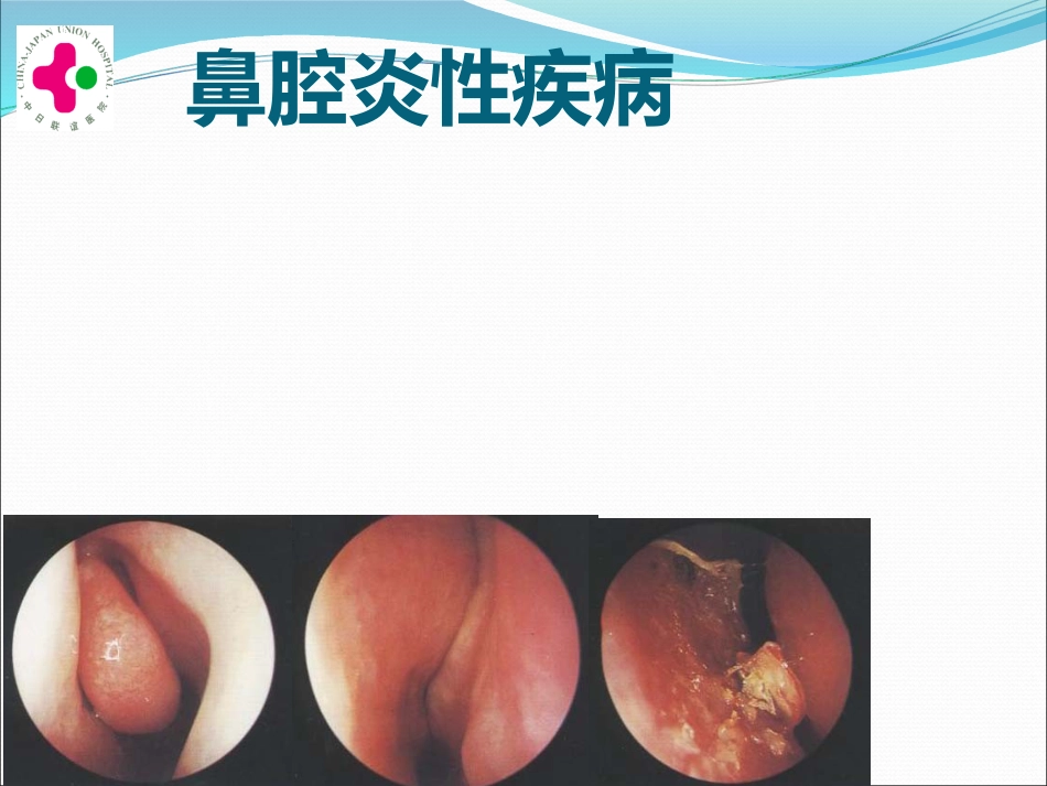 白求恩医疗班慢性鼻炎变应性鼻炎鼻息肉讲义_第2页
