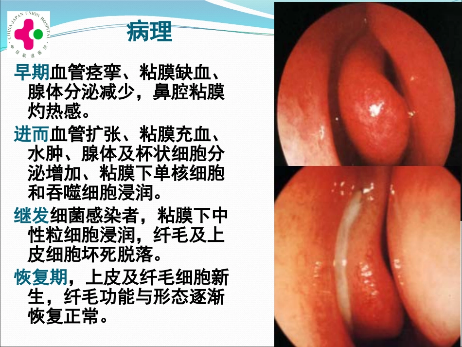 白求恩医疗班慢性鼻炎变应性鼻炎鼻息肉讲义_第4页