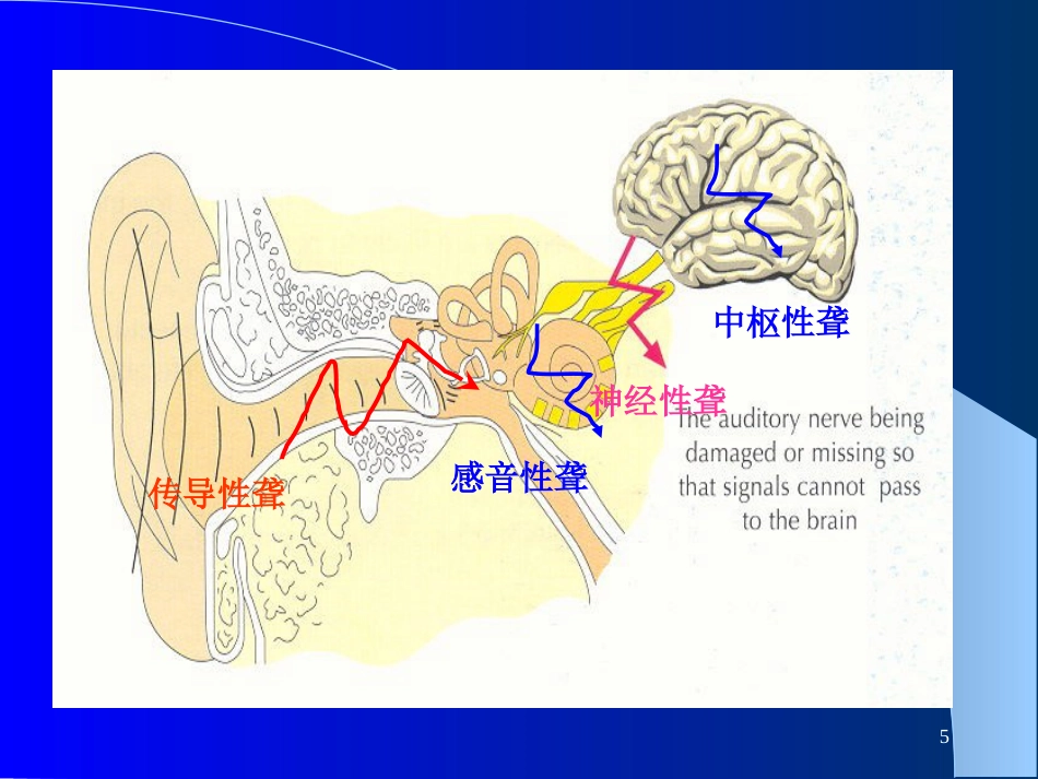耳鼻咽喉-头颈外科聋及其防治_第5页