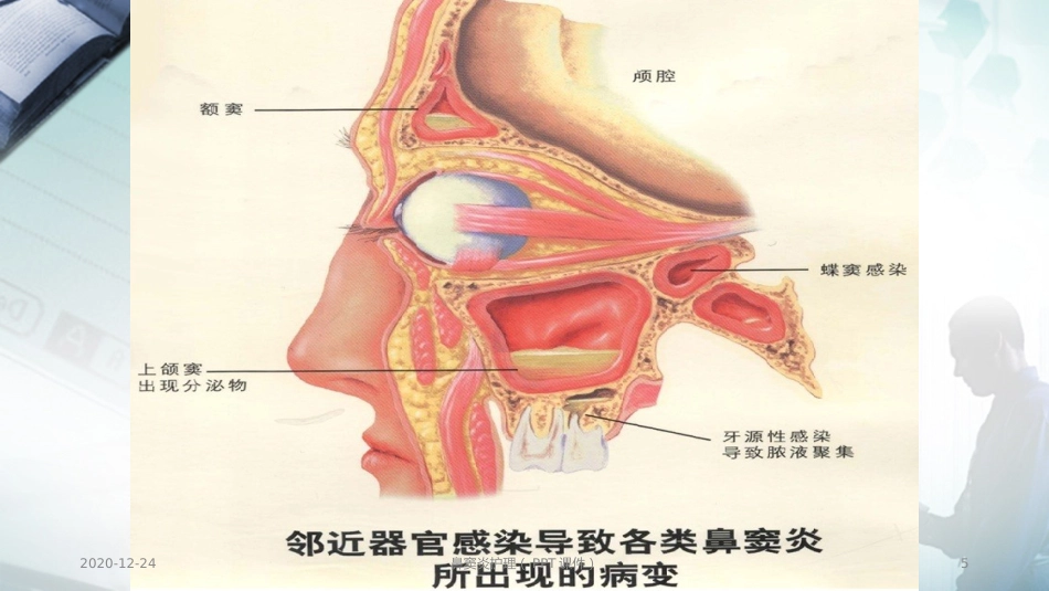 鼻窦炎护理(PPT课件)_第5页