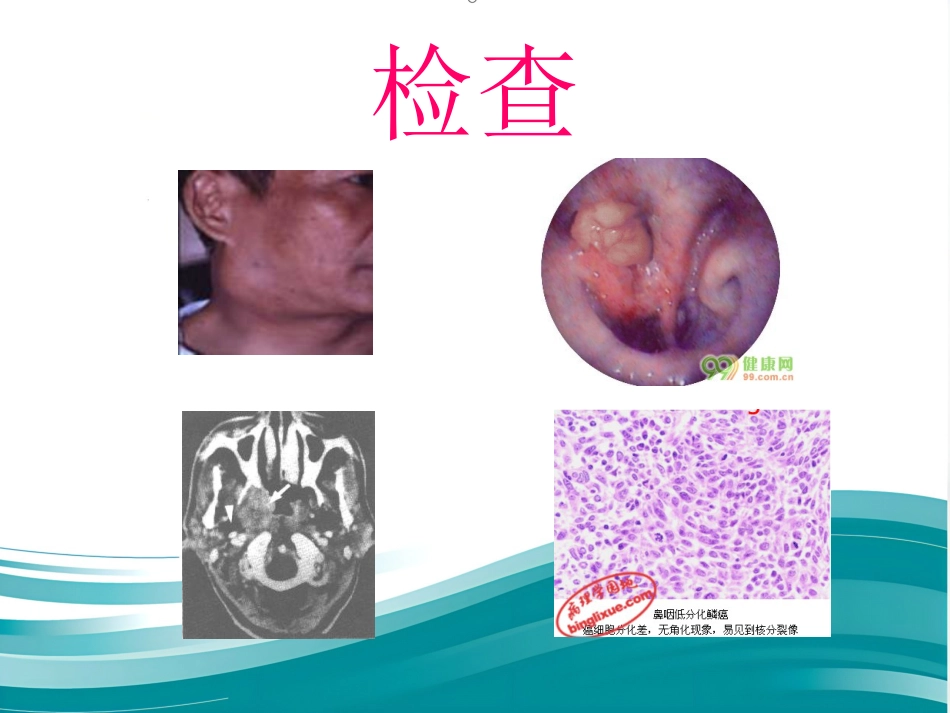鼻咽癌_第8页