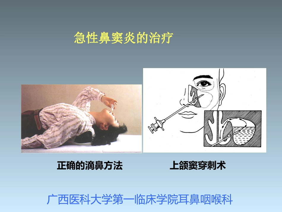 鼻窦炎_第12页