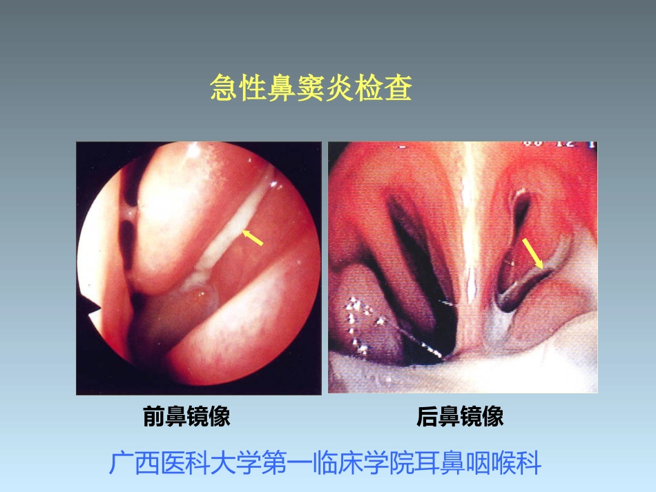 鼻窦炎_第8页