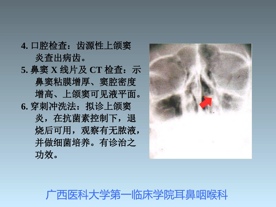 鼻窦炎_第9页