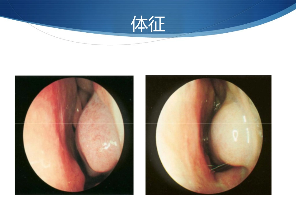 变应性鼻炎与冬病夏治_第7页