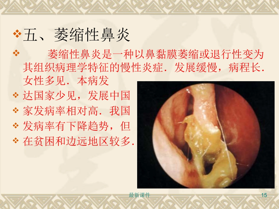 鼻炎鼻窦炎PPT课件_第15页