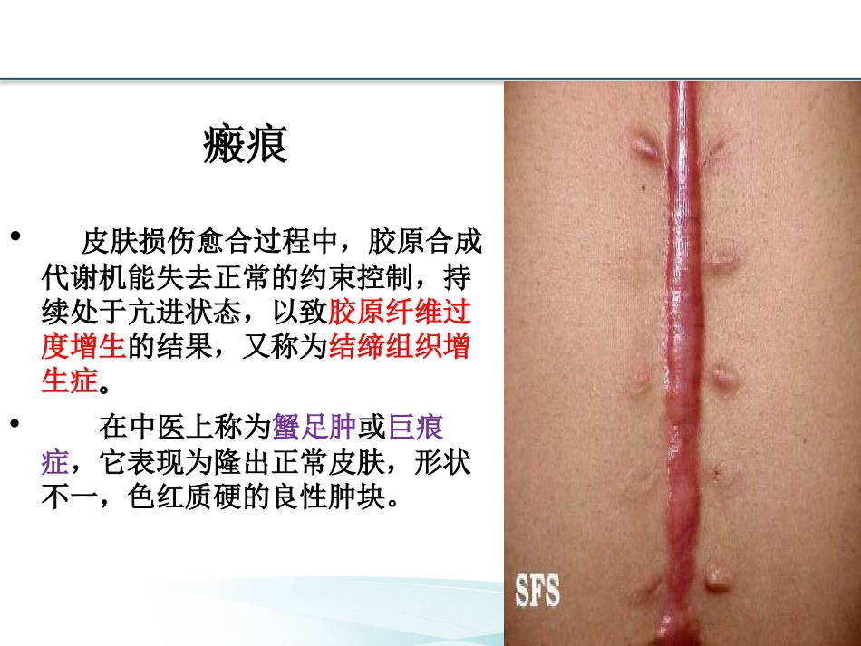 耳部瘢痕疙瘩讲诉_第3页