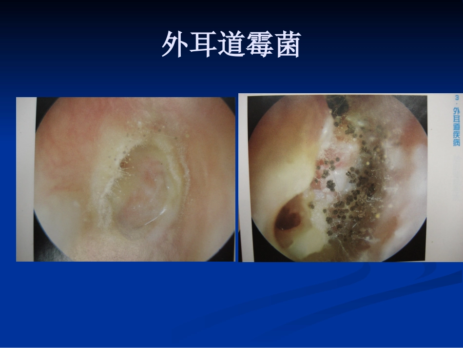 耳鼻咽喉头颈外科学外耳疾病_第12页