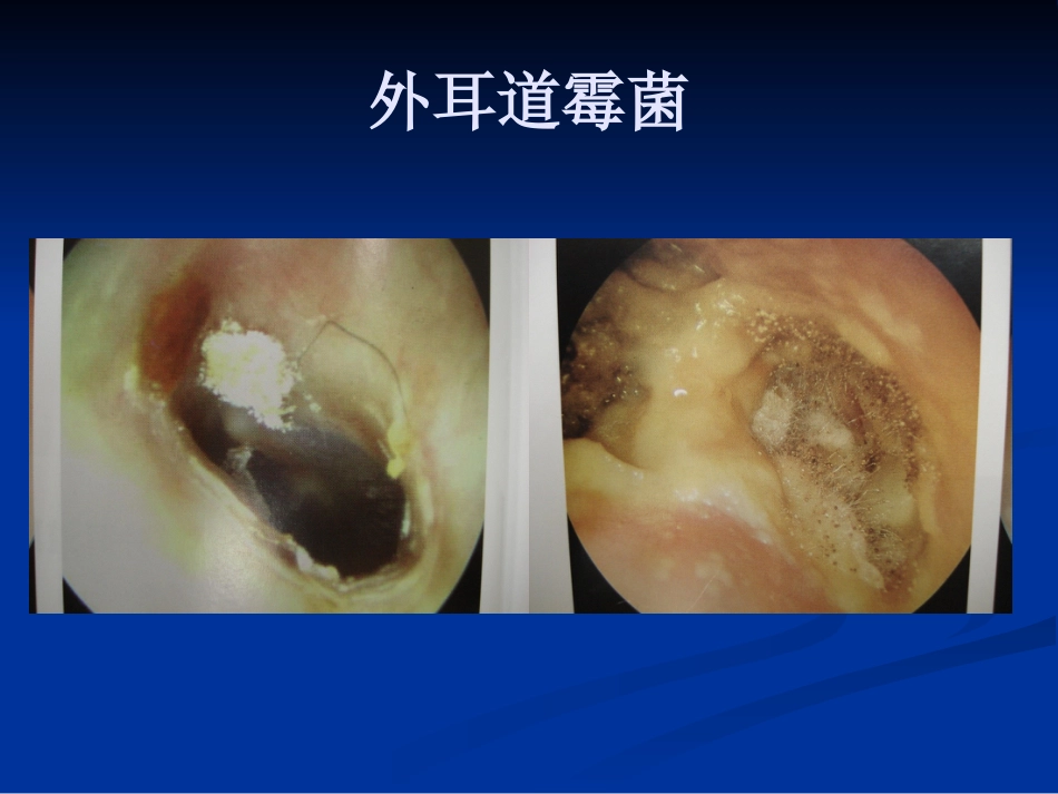 耳鼻咽喉头颈外科学外耳疾病_第13页