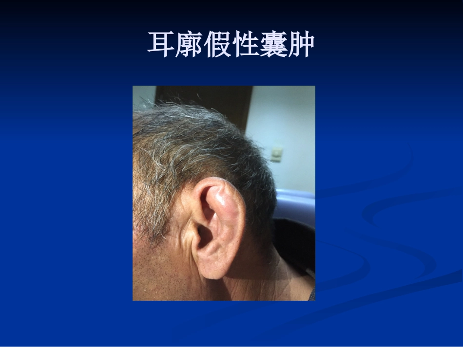 耳鼻咽喉头颈外科学外耳疾病_第15页