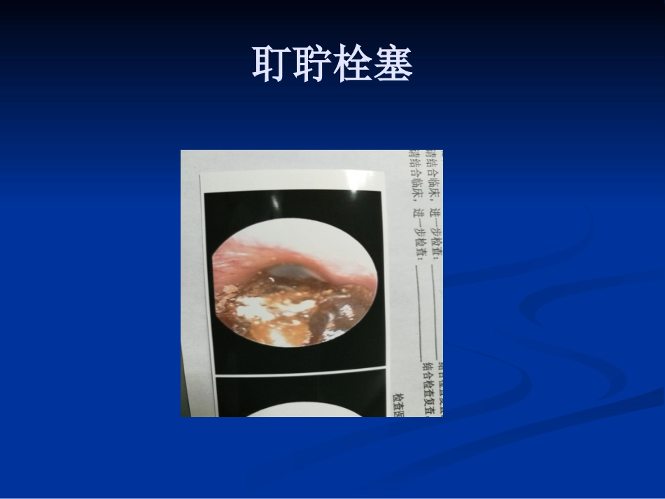 耳鼻咽喉头颈外科学外耳疾病_第3页