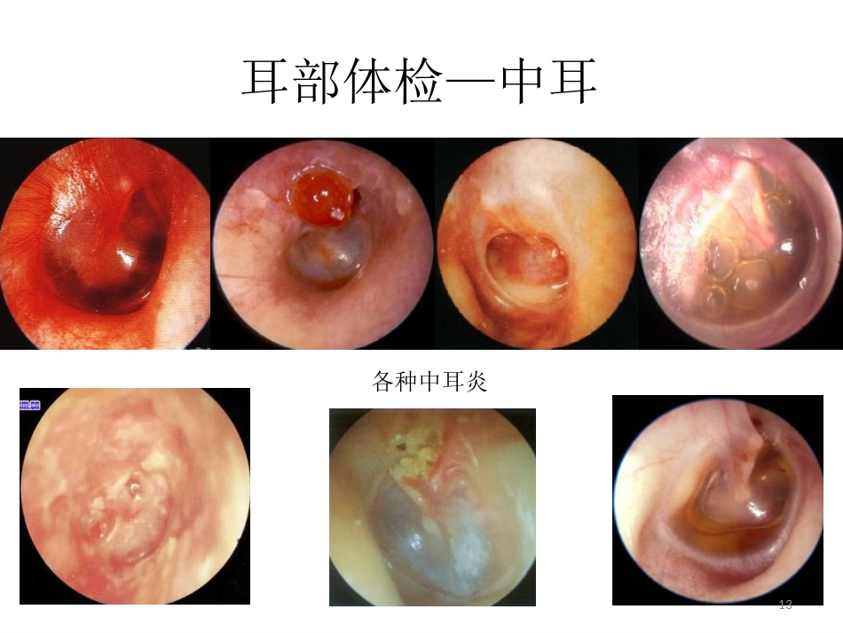 耳鼻喉科一般检查PPT课件_第13页