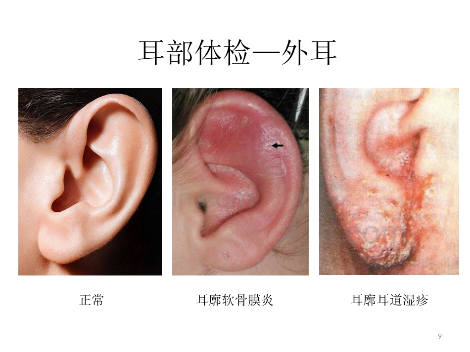 耳鼻喉科一般检查PPT课件_第9页