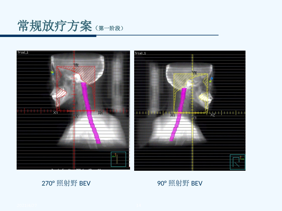 鼻咽癌的放射治疗技术_第14页