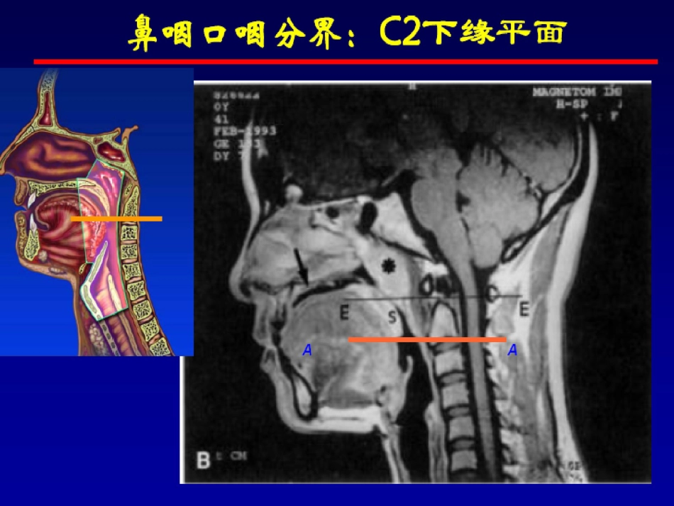 鼻咽癌的放射治疗课件_第10页