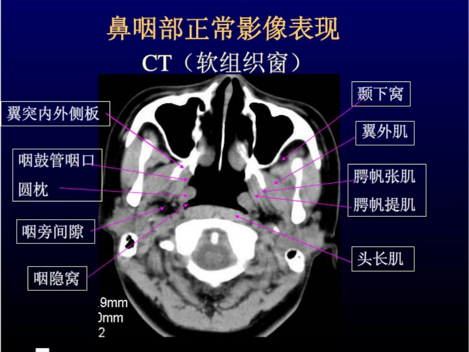 鼻咽癌的放射治疗课件_第8页