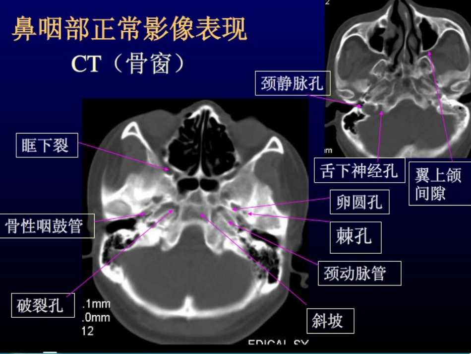 鼻咽癌的放射治疗课件_第9页