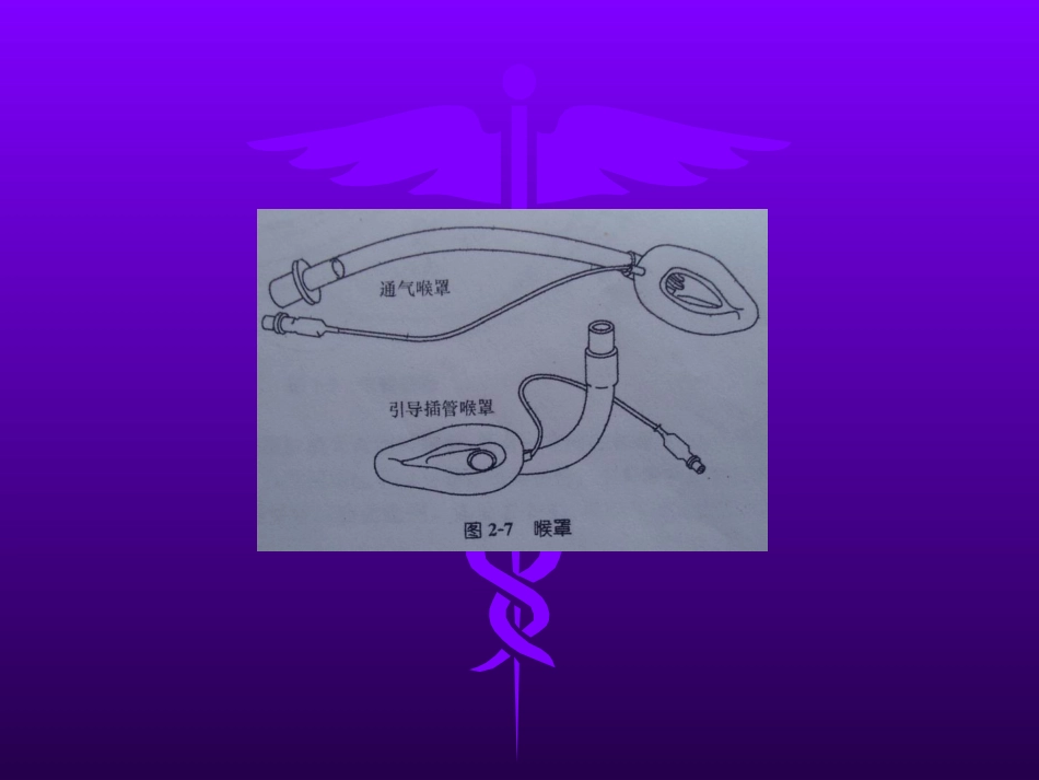 喉罩的临床应用_第10页