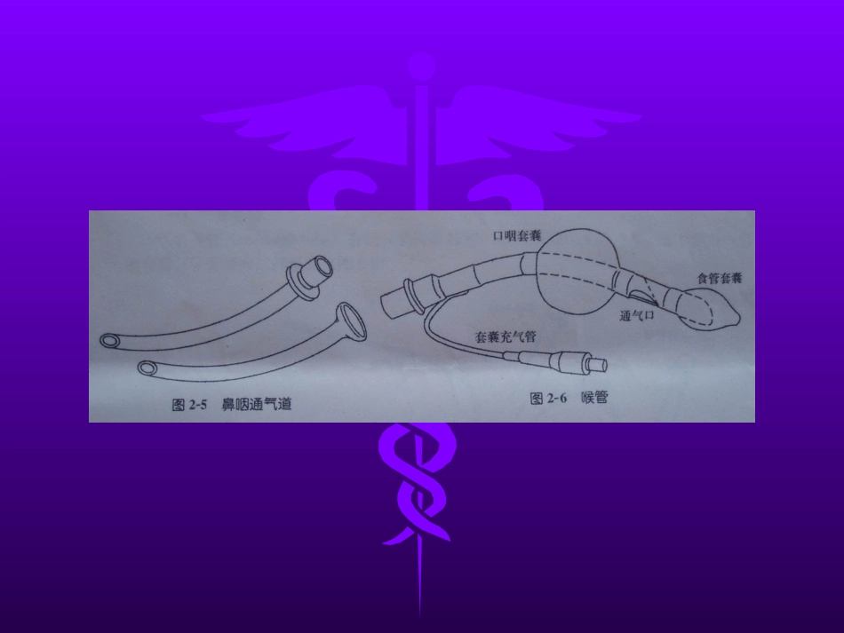 喉罩的临床应用_第9页