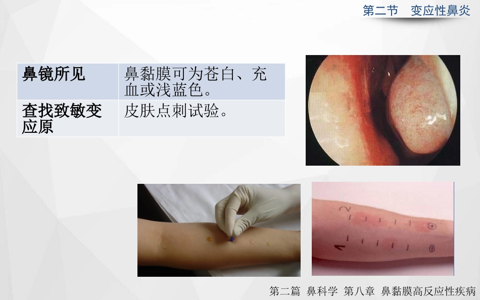 变应性鼻炎正式_第8页
