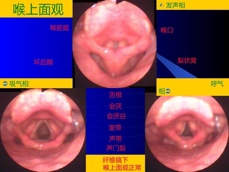 喉解剖急性会厌炎急慢性喉炎ppt课件_第14页