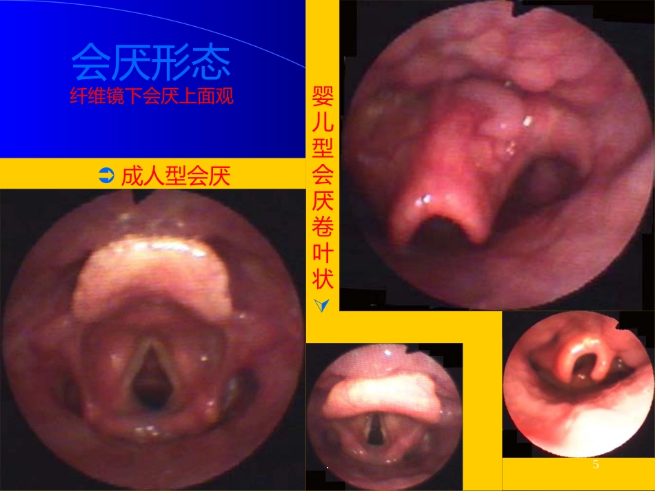 喉解剖急性会厌炎急慢性喉炎ppt课件_第5页