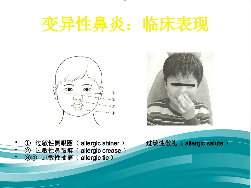 变应性鼻炎的诊断与治疗_第7页