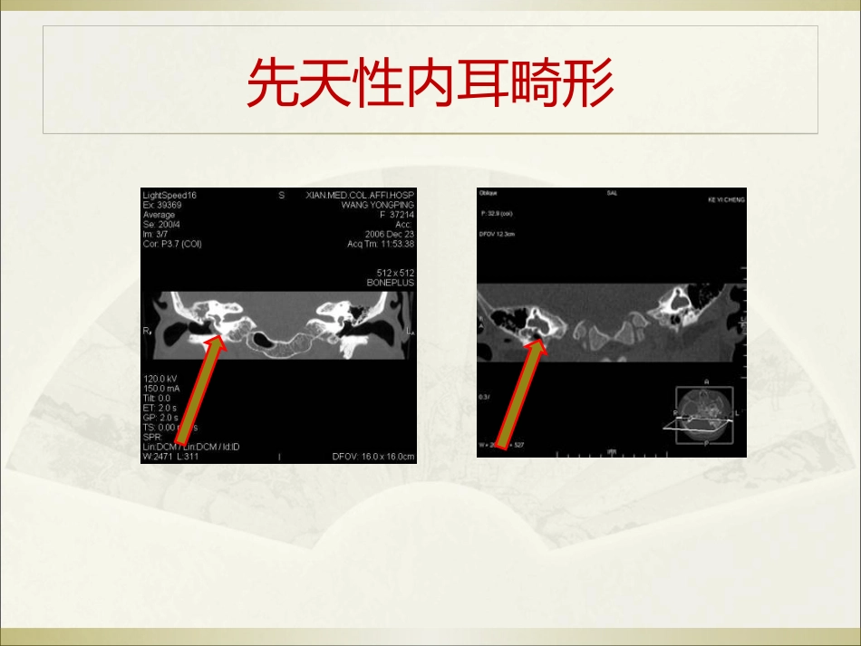耳科常见疾病_第9页