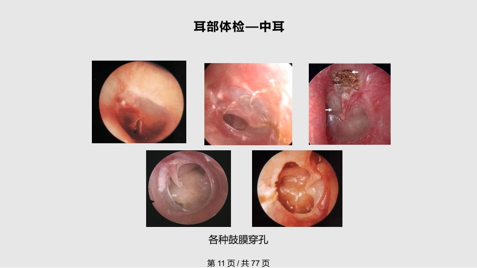 耳鼻喉科体检PPT课件_第11页