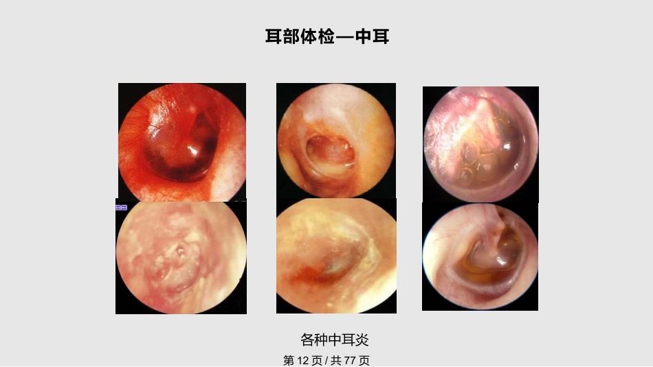 耳鼻喉科体检PPT课件_第12页