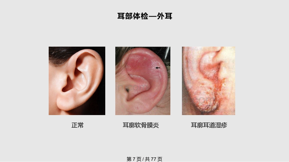 耳鼻喉科体检PPT课件_第7页