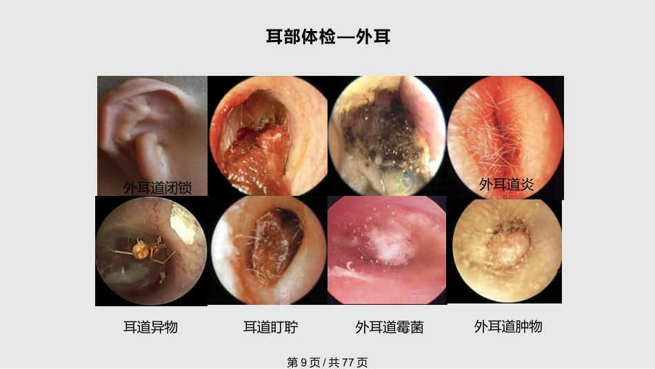 耳鼻喉科体检PPT课件_第9页