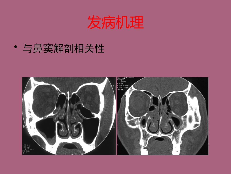 鼻窦炎及并发症ppt课件_第3页