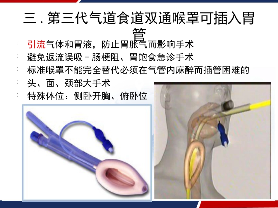 喉罩的临床应用 PPT_第6页