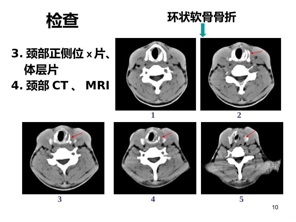 喉的疾病(喉科学)PPT课件_第10页