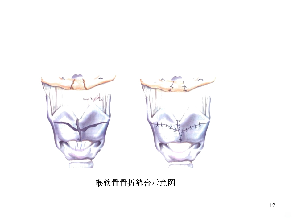 喉的疾病(喉科学)PPT课件_第12页