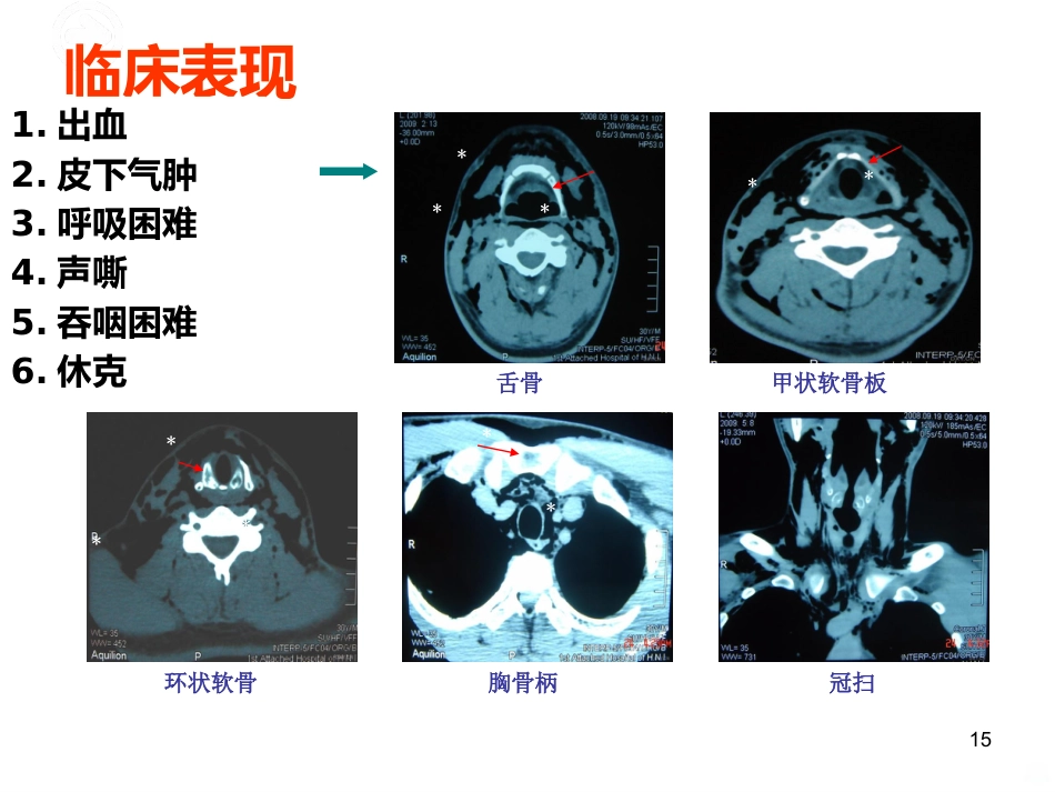 喉的疾病(喉科学)PPT课件_第15页