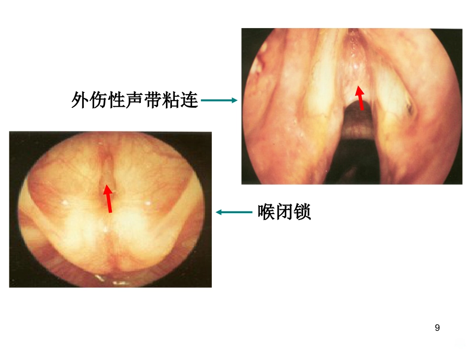 喉的疾病(喉科学)PPT课件_第9页