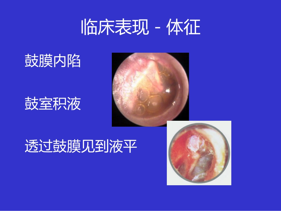 耳鼻咽喉头颈外科学课件分泌性中耳炎_第11页