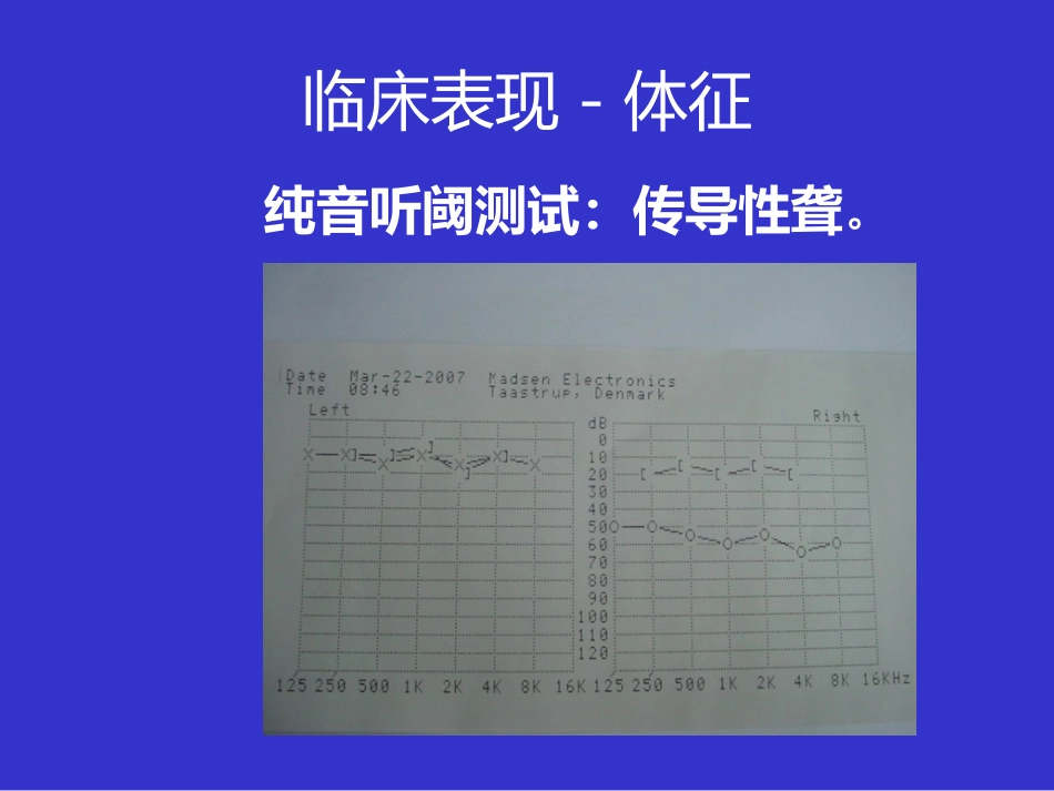 耳鼻咽喉头颈外科学课件分泌性中耳炎_第12页