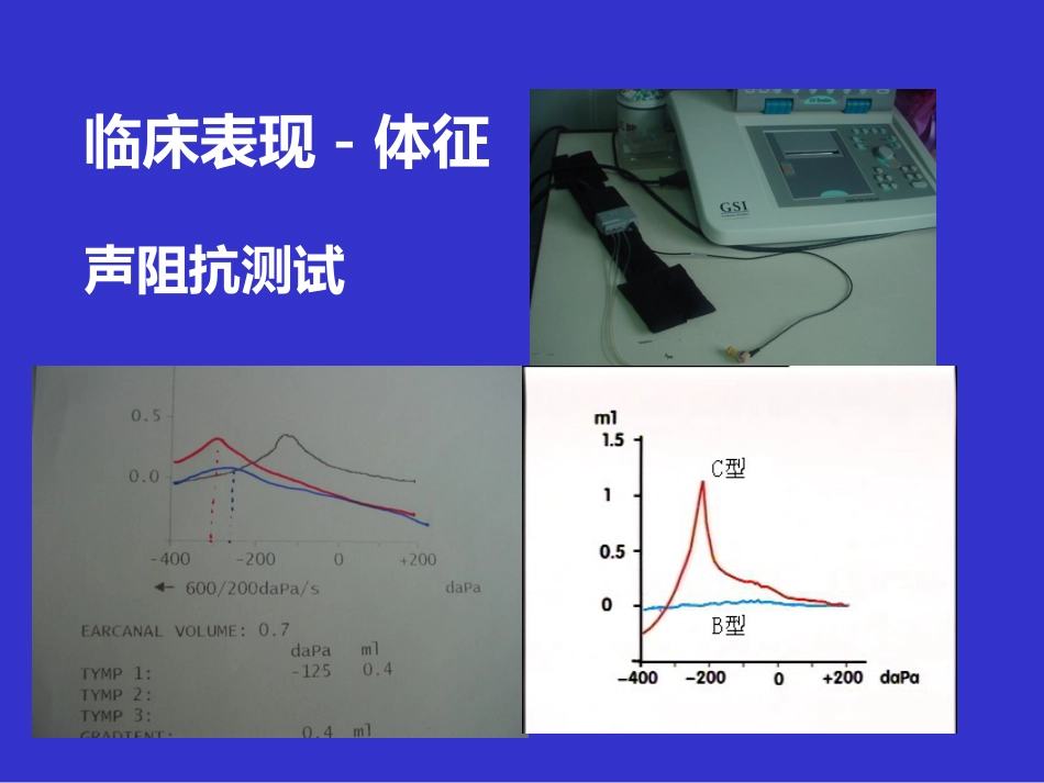 耳鼻咽喉头颈外科学课件分泌性中耳炎_第13页