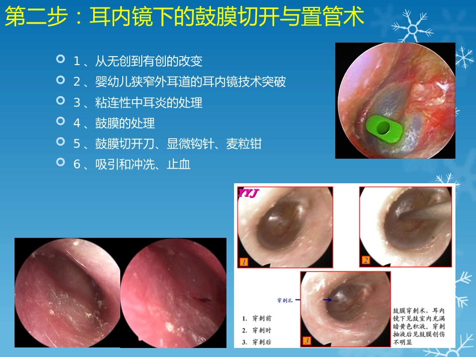 耳鼻喉科-如何学习耳内镜_第4页