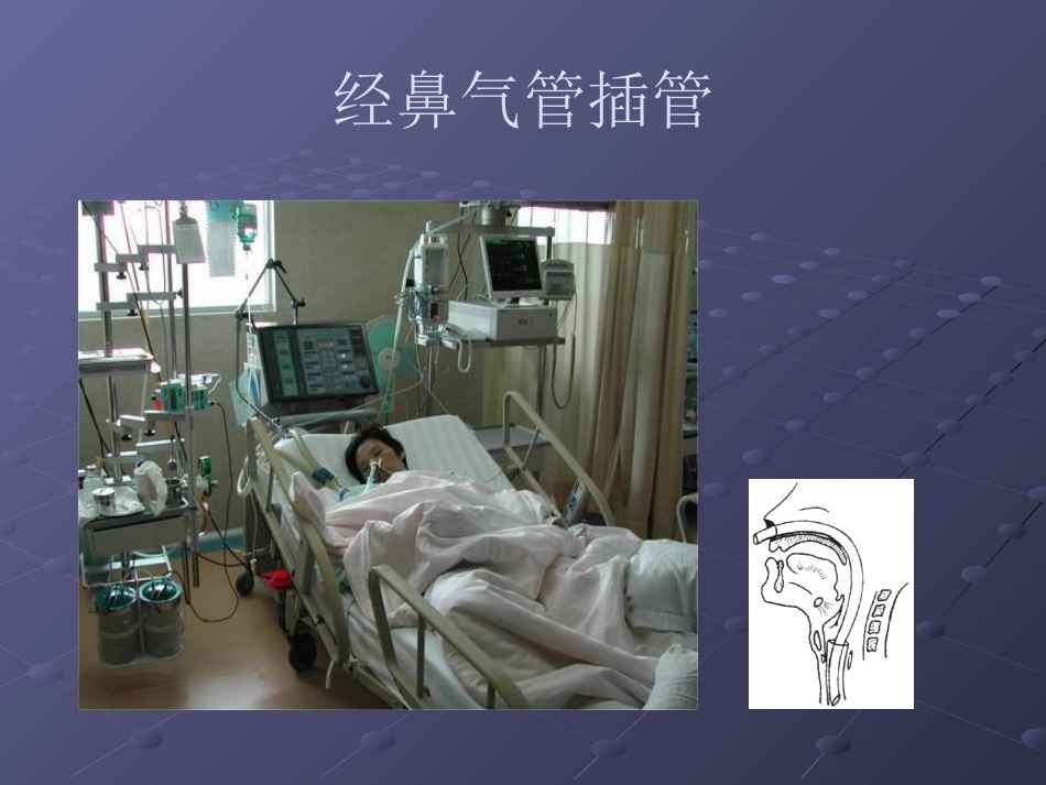 经鼻气管插管NTI_第3页