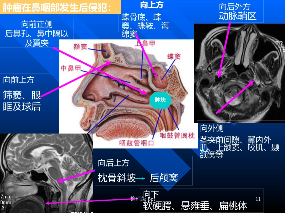 鼻咽癌靶区勾画_第11页