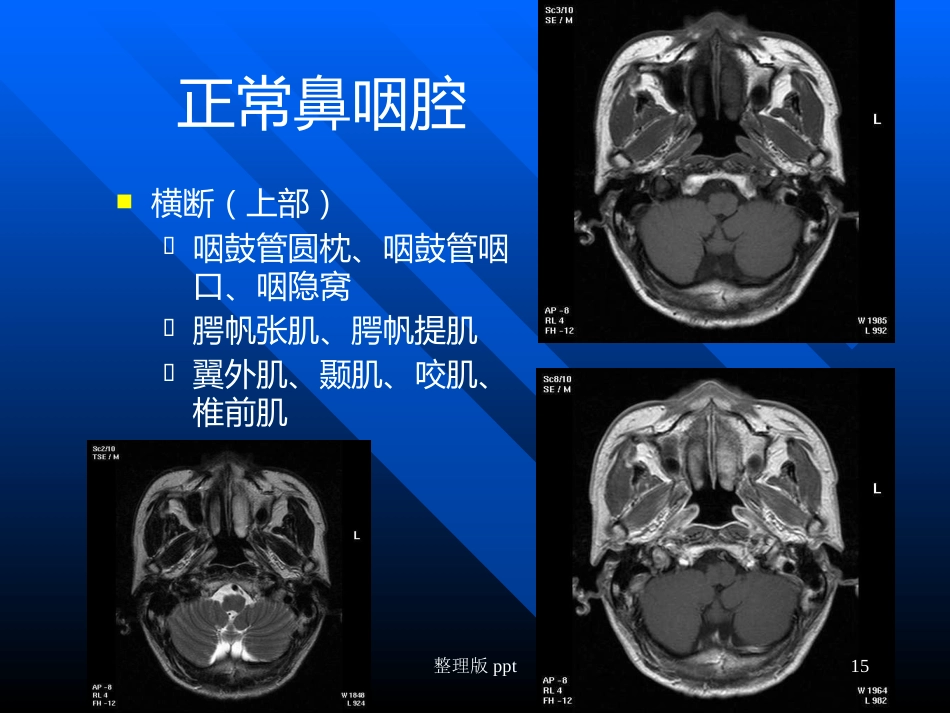 鼻咽癌靶区勾画_第15页