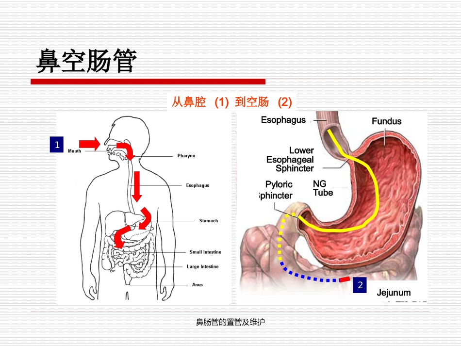 鼻肠管的置管及维护_第5页